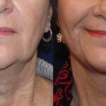 How Do Full and Mini Facelifts Differ?