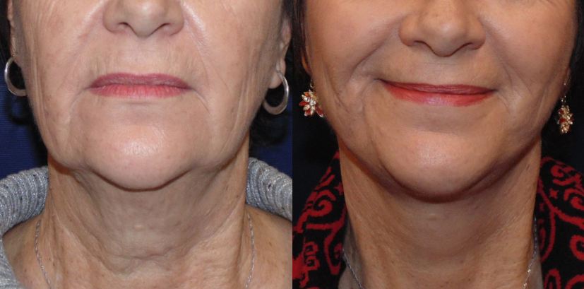 How Do Full and Mini Facelifts Differ?